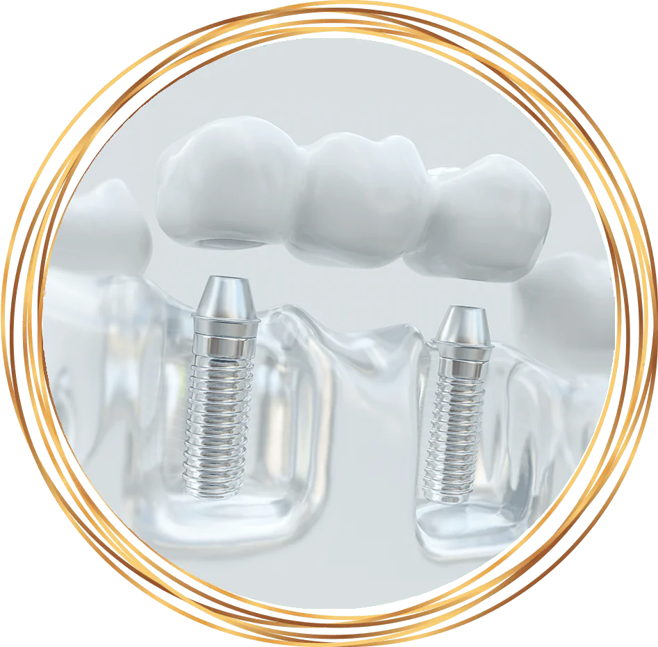 dental implant bridge