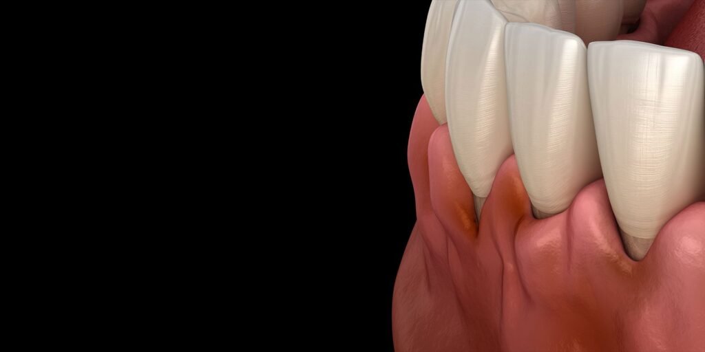 receding and inflamed gums 3d render