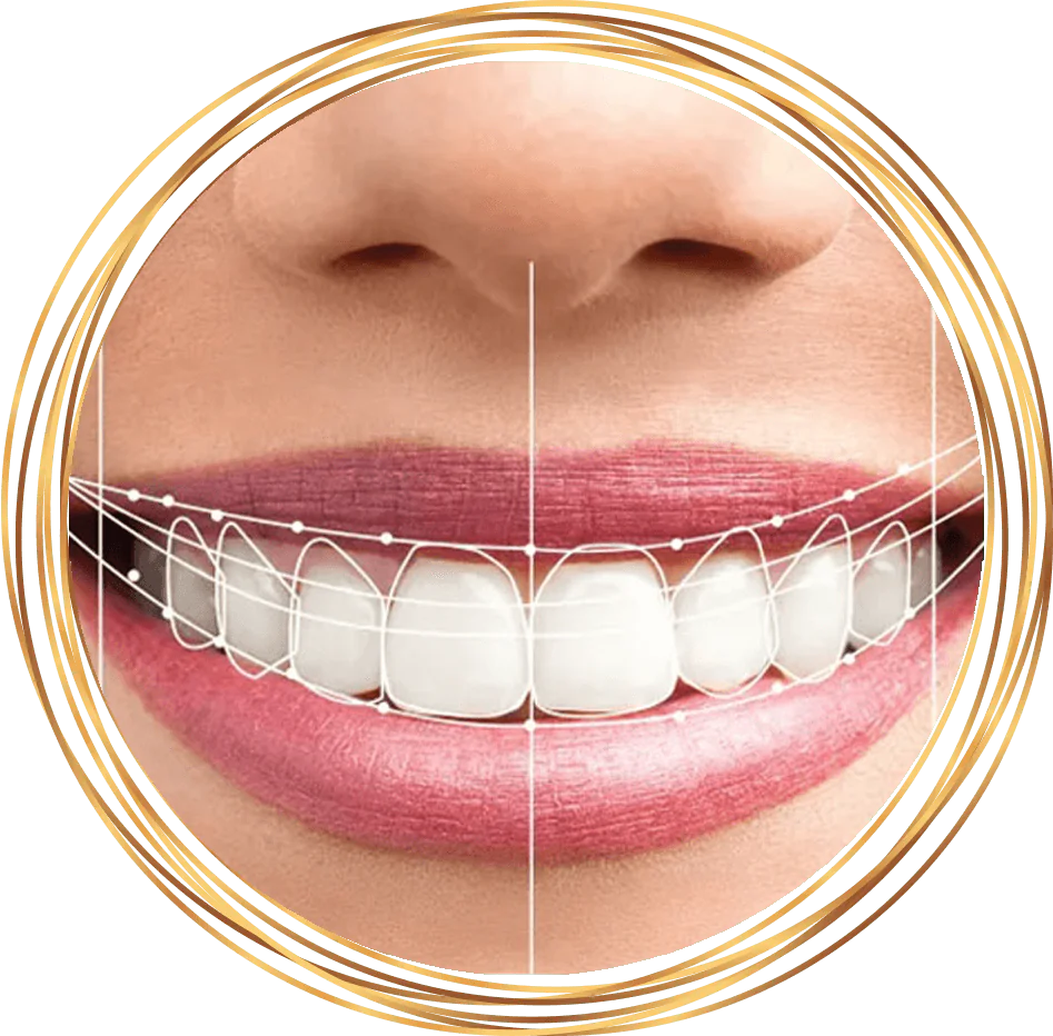 dental patient smiling with lines on teeth indicating measurements
