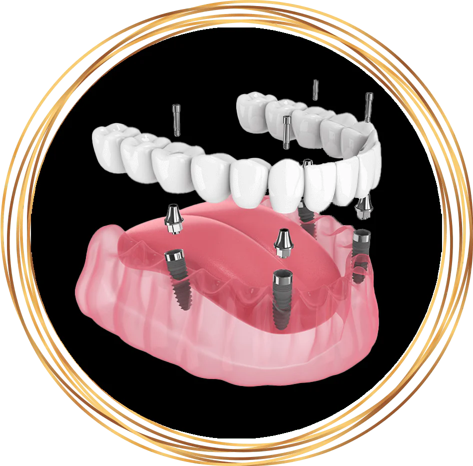 all on 4 fixed dental implants