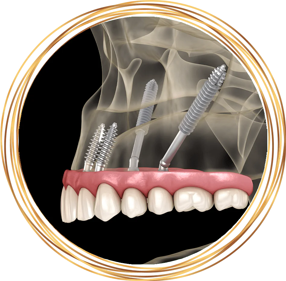 zygomatic dental implants 3d rendering